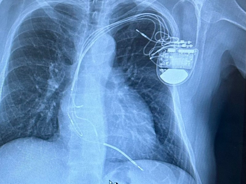 A Doozy of a&nbsp;Surgery